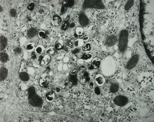 M,8y. | Wilson disease susp.